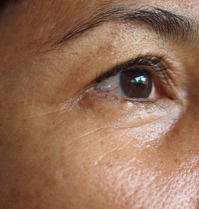 Before eye area wrinkle reduction treatment