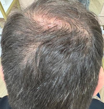 After hair restoration treatment showing fuller thicker hair