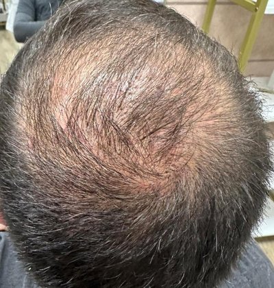 Before hair restoration treatment showing thinning hair
