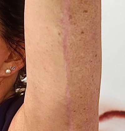 After scar reduction treatment