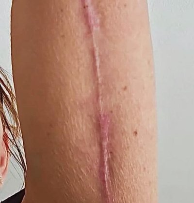 Before scar reduction treatment