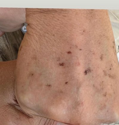 After age spot removal