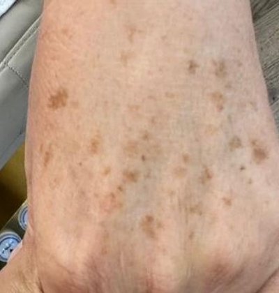 Before age spot removal