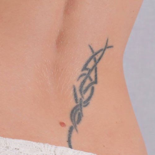 Before tattoo removal treatment