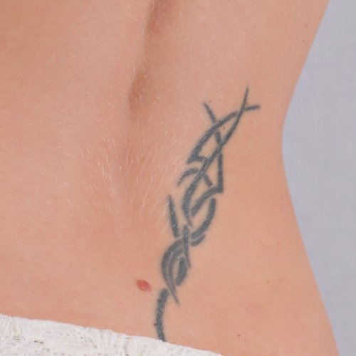 Before tattoo removal treatment