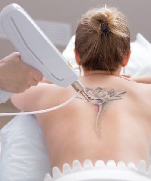 Laser tattoo removal treatment