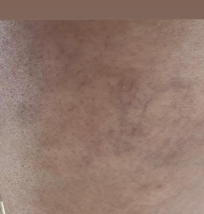 Before spider vein removal