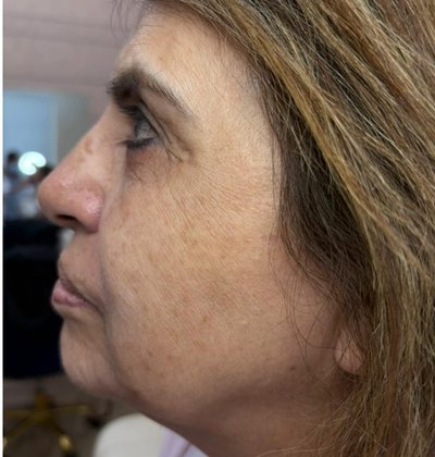 Before full face lifting treatment